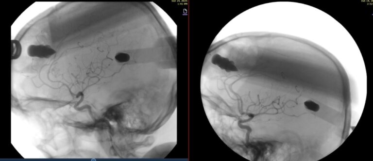 نزيف-دماغي-غامض.-جراحة-دقيقة-تنقذ-مريضاً-بمستشفى-الدرعية