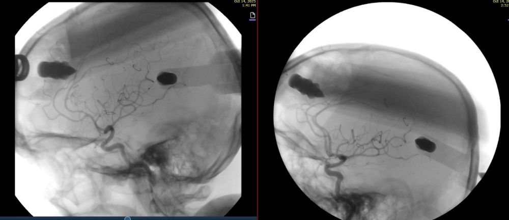 نزيف-دماغي-غامض.-جراحة-دقيقة-تنقذ-مريضاً-بمستشفى-الدرعية