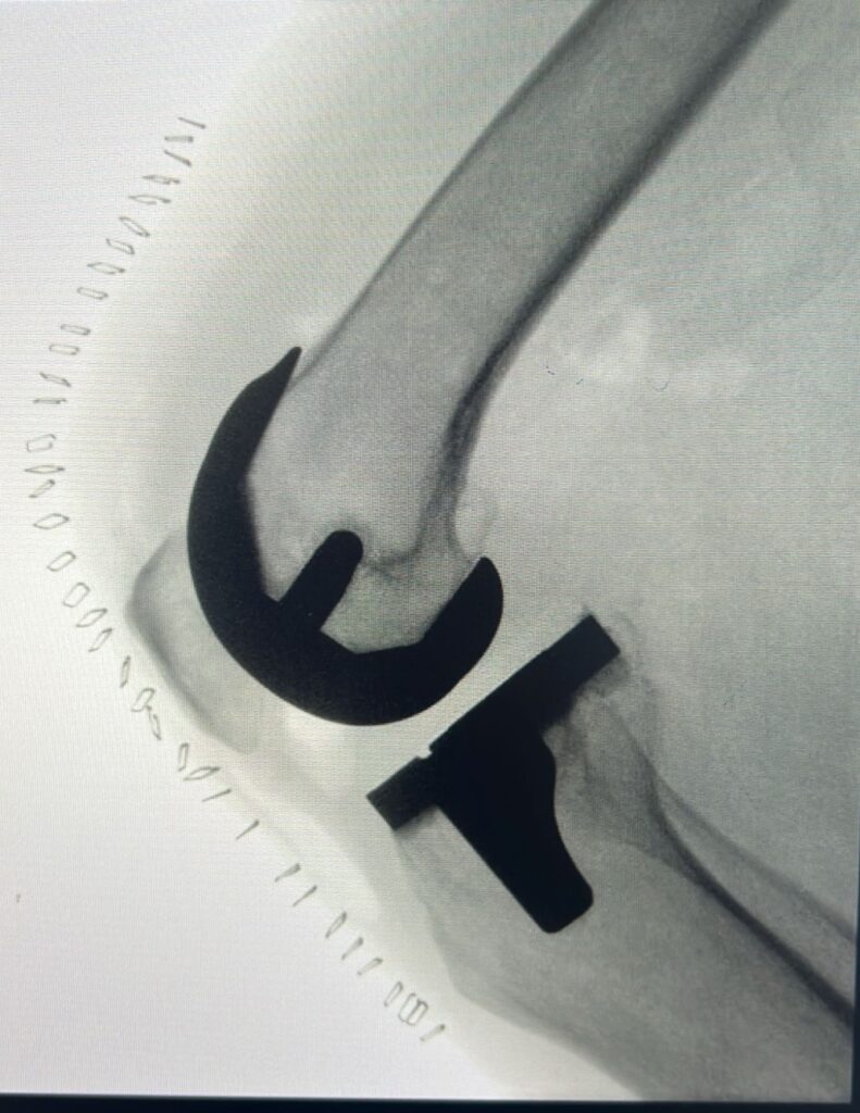 بتقنيات حديثة.. استبدال مفصل الركبة والمشي دون ألم في نفس اليوم 51 بتقنيات-حديثة.-استبدال-مفصل-الركبة-والمشي-دون-ألم-في-نفس-اليوم