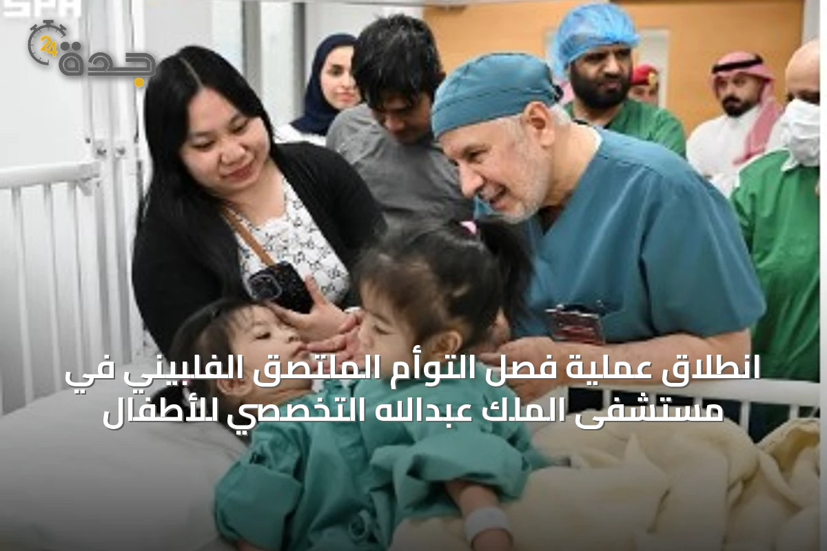 انطلاق عملية فصل التوأم الملتصق الفلبيني في مستشفى الملك عبدالله التخصصي للأطفال