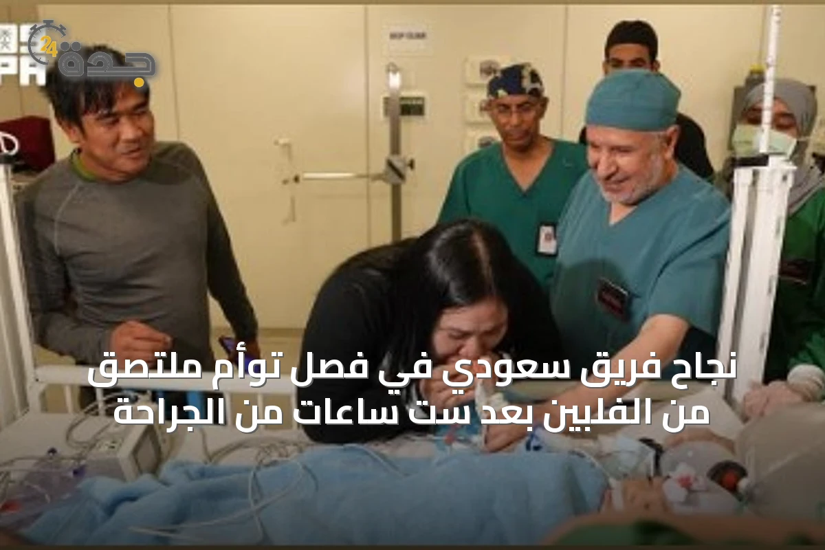 نجاح فريق سعودي في فصل توأم ملتصق من الفلبين بعد ست ساعات من الجراحة