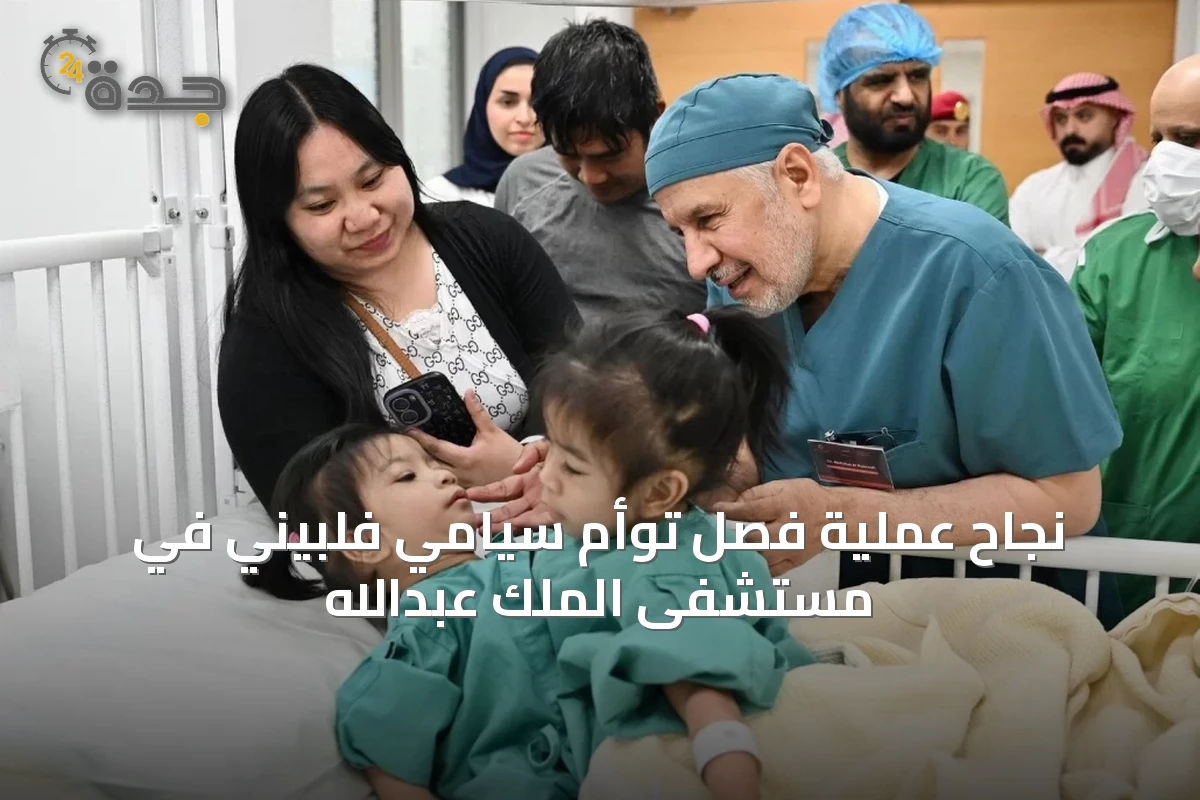 نجاح عملية فصل توأم سيامي فلبيني في مستشفى الملك عبدالله