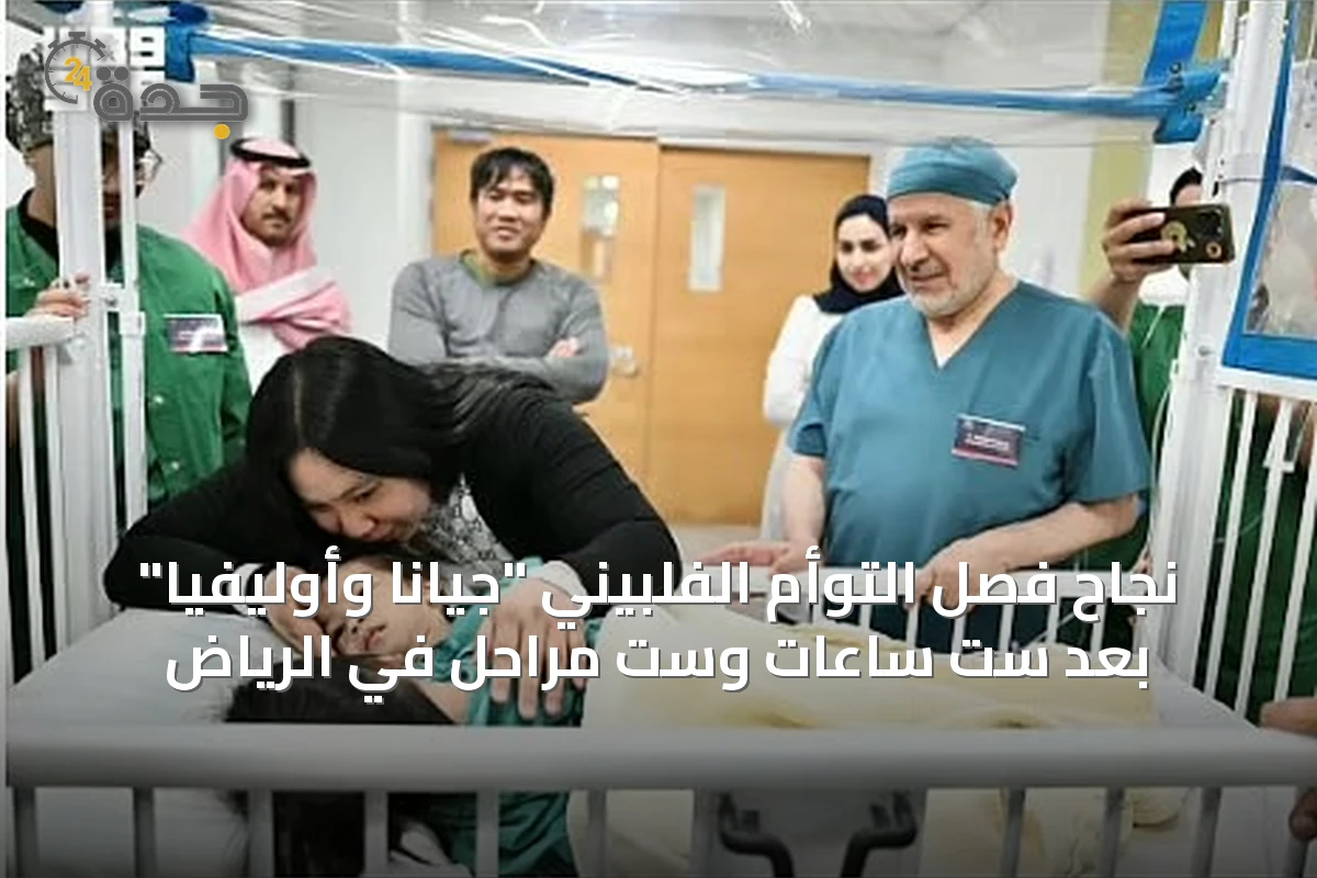 نجاح فصل التوأم الفلبيني "جيانا وأوليفيا" بعد ست ساعات وست مراحل في الرياض
