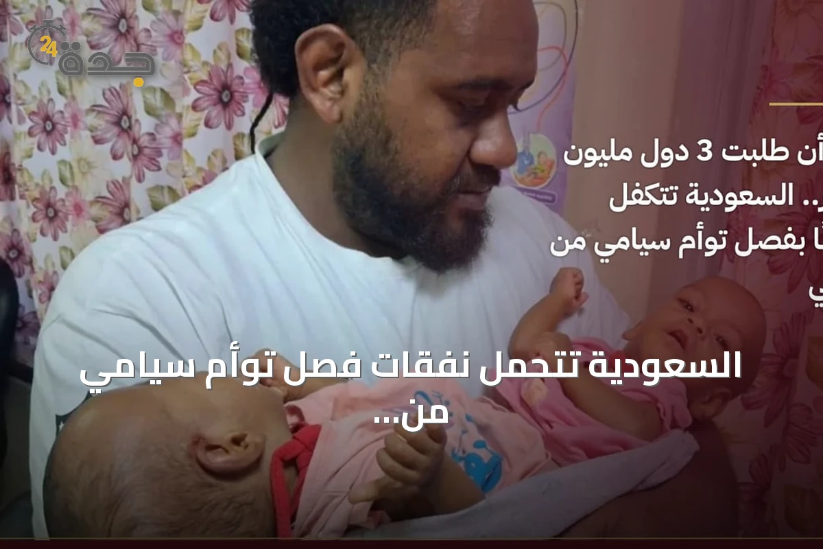 السعودية تتحمل نفقات فصل توأم سيامي من فيجي بعد رفض دول دفع مليون دولار