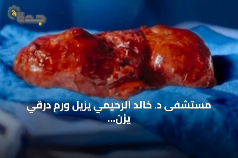 مستشفى د. خالد الرحيمي يزيل ورم درقي يزن 2.5 كغ دون فتح القص