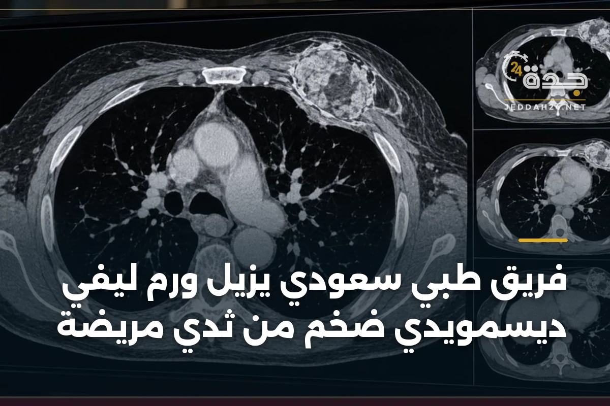فريق طبي سعودي يزيل ورم ليفي ديسمويدي ضخم من ثدي مريضة