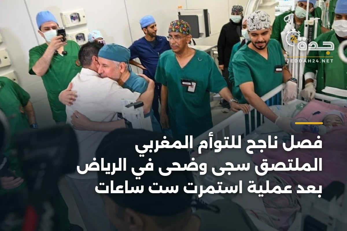 فصل ناجح للتوأم المغربي الملتصق سجى وضحى في الرياض بعد عملية استمرت ست ساعات