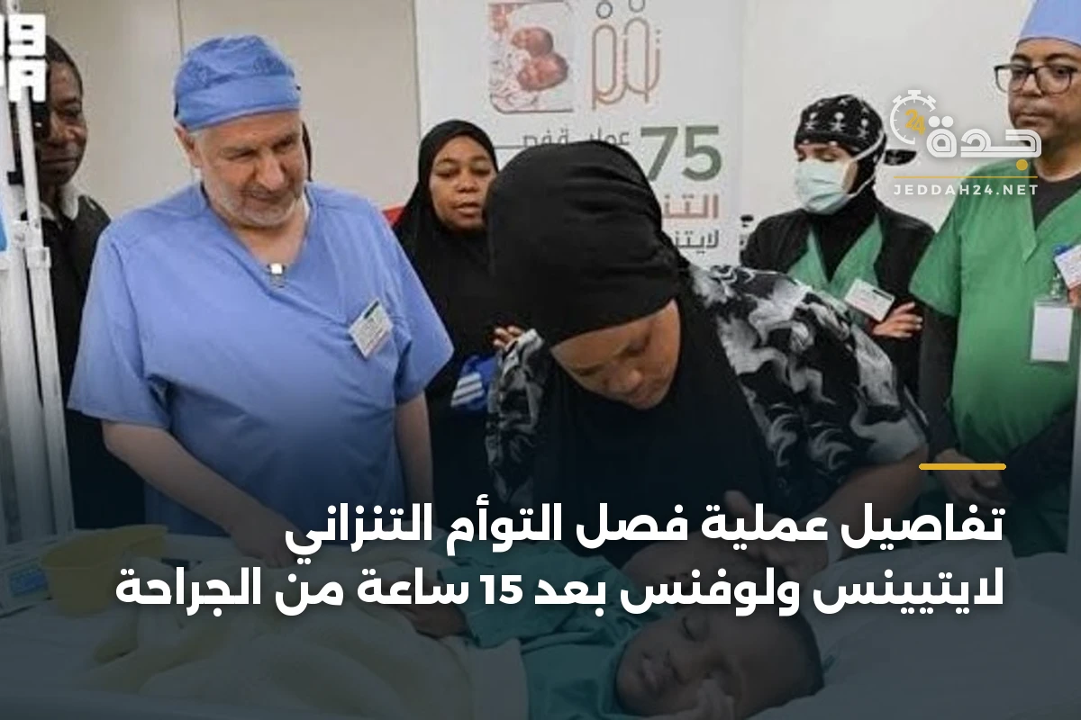 تفاصيل عملية فصل التوأم التنزاني لايتيينس ولوفنس بعد 15 ساعة من الجراحة